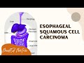 Squamous cell carcinoma of esophagus | Risk factors | Pathogenesis | Morphology | Clinical features