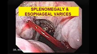 SPLENOMEGALY \u0026 ESOPHAGEAL VARICES IN LIVER FAILURE I 2ND MBBS IN PRC I DR.P.HARINATH I 2014