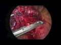 biportal vats superior segmentectomy of the left lower lobe