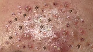 Loan Nguyen Acne Treatment 54x
