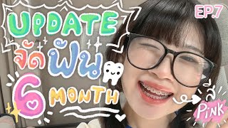 🦷UPDATE🦷 จัดฟันครบ 6 เดือน ครึ่งปีแน้วว!! กับสียางใหม่แบ๊วๆใสๆ💖💕 EP.7 (มอตี่) | SOMz