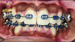 BRACES JOURNEY OF SEVERELY CROOKED TEETH