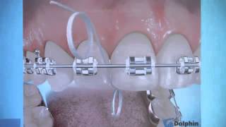 How to Care for Your Braces