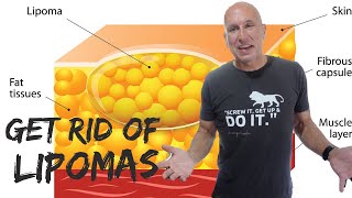 Lion Diet Rid My Body of Lipomas WITHOUT SURGERY!