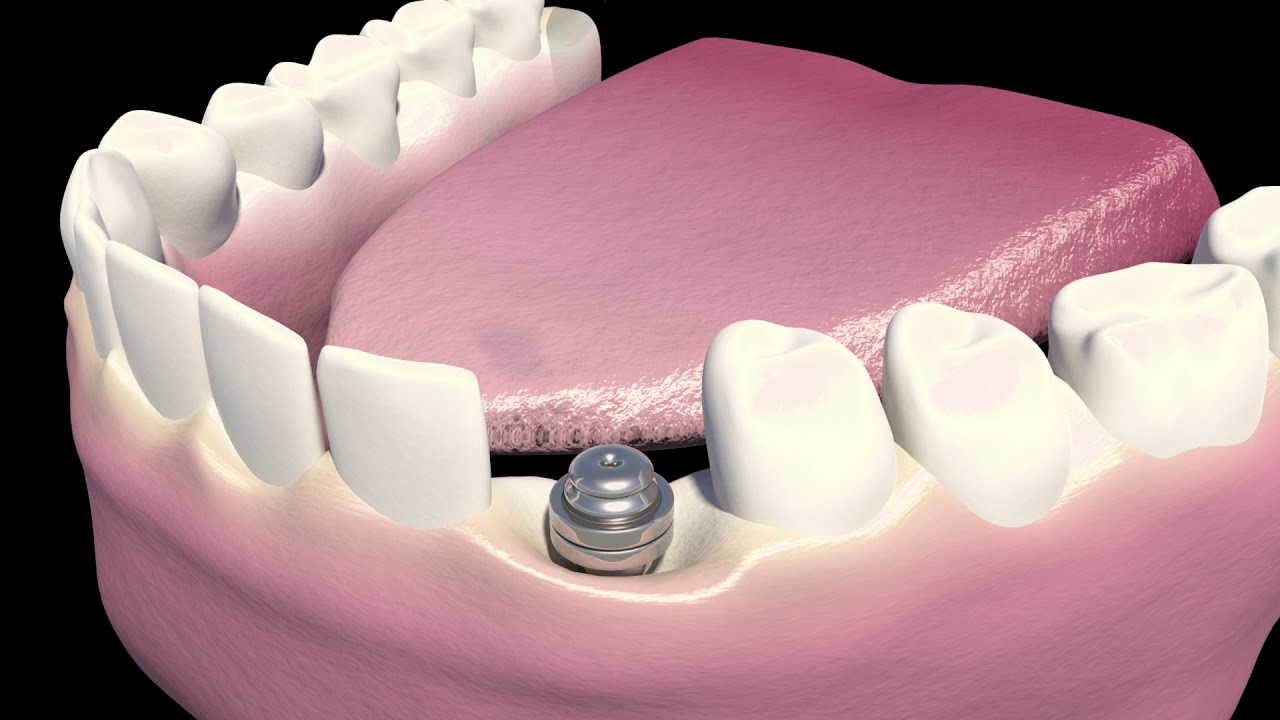 Dental Implants Youtube