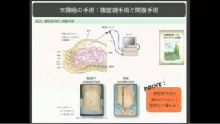 大腸がんの手術について- 竹政 伊知朗