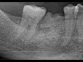 Root stump of lower second molar removal with elevators