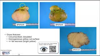 Musculoskeletal system: Lipoma (Gross pathology)