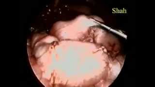 Laparoscopic Surgery for pyloric Stenosis (obstruction to stomach) in a child