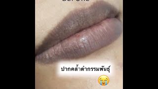 ทุกปัญหาปากคล้ำดำแก้ไขได้ Baby-Lip Treatment l Lip-tattooing katekorea