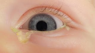 How to treat a sticky eye in a baby