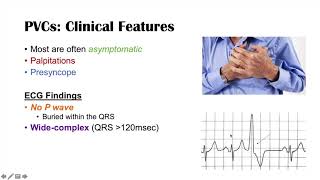 A Common Cause of Palpitations | Premature Ventricular Contractions (PVCs): Triggers & Symptoms