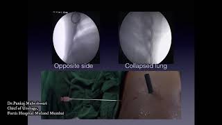 How to manage under dilatation of supracostal access, Talk by Dr. Pankaj Maheshwari