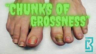 “Chunks of Grossness”