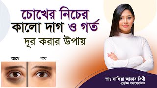 চোখের নিচের কালো দাগ দূর করবেন কী করে। চোখের নিচে কালো দাগ ও গর্ত দূর করার উপায়।