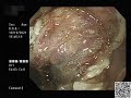 早期下咽癌 內視鏡切除 esd hypopharyngeal cancer