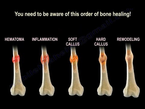 What is it called when your bones break easily?