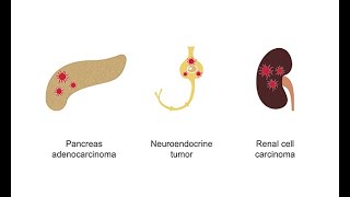 Ordering the right abdominal CT study for cancer staging