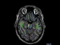 medial lemniscus axial 2d