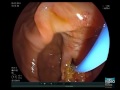 periampullary diverticulum cannulation and sphincterotomy