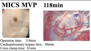 3D endoscopic MICS MVP  118min / 完全鏡視下僧帽弁形成術　118分