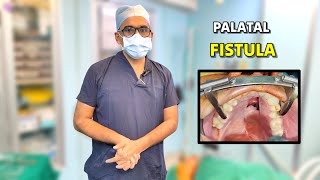 Big Palatal Fistula Closure using Tounge Flap by Dr Parit Ladani