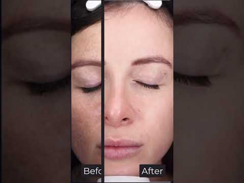 Customized treatment plans to improve skin color with CüR Laser and Skin