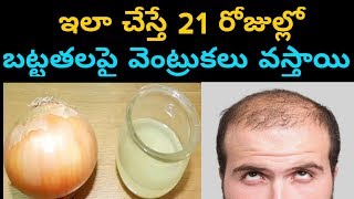 ఇలా చేస్తే 21 రోజుల్లో బట్టతలపై వెంట్రుకలు వస్తాయి || How To prevent Bald Hair in Telugu