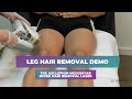 Asclepion MeDioStar Diode Laser Demo for Leg Hair Removal