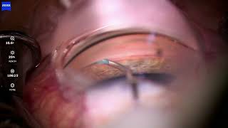 OMNI Teaching Video - Confirming Catheter is in the Canal- I Paul Singh