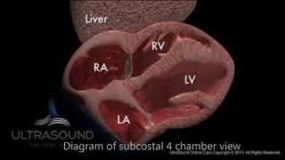 Bubble test, rapid confirmation of central line position using bedside ultrasonography