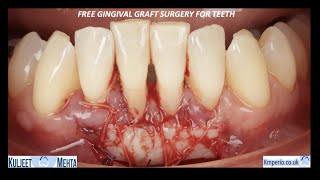 Free Gingival Graft Surgery.