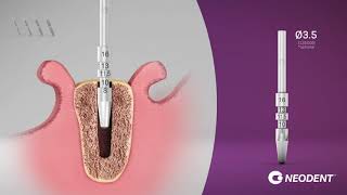 Secuencia de fresado Implante Helix Grand Morse (Hueso III y IV)