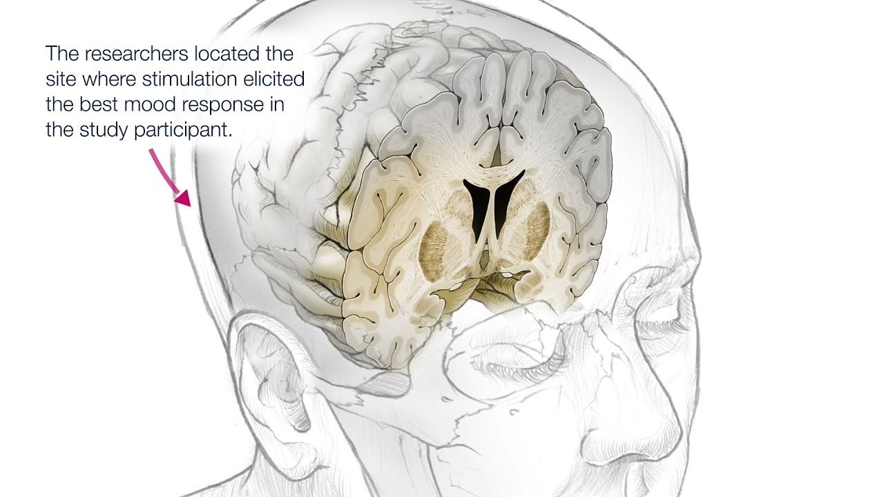 Personalized Deep Brain Stimulation Therapy (DBS) - YouTube