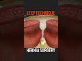 etep technique for ventral hernia