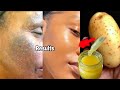 I Try,It remove my dark spots In 3 Day's potato face serum for sunburn, scars,skin whitening, pimple