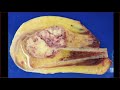 bone tumor pathology basics medical students orthopedic surgery usmle board review