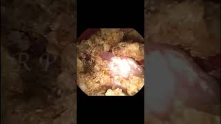 All Kidney Stone Fragments Removed with RIRS Technology.