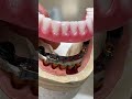 Removable hybrid denture!