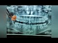 ⏭️ muela del juicio 👅 short dental terceramolar