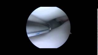 Meniscal Repair Info from a Phoenix Orthopedic Surgeon