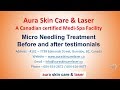 Aura skin care laser   Micro needling results