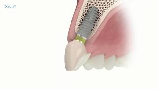 Xive - Temporary single tooth restoration