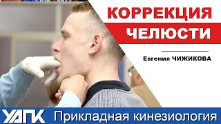 Коррекция шва верхней челюсти (Е.Чижикова)