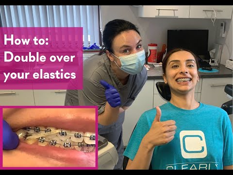 What are the rubber bands for braces for?