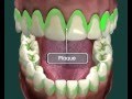 Tooth Decay -- How it Happens and How to Avoid it Tooth Decay -- How it Happens and How to Avoid it