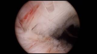 Top Down HoLEP approach for BPH