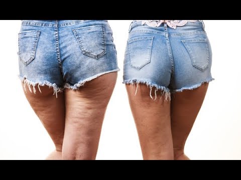 How to Eliminate Cellulite on Your Thighs in 2 Weeks How to Eliminate Cellulite on Your Thighs in 2 Weeks