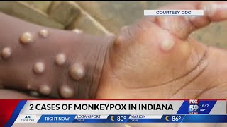 Indiana reports second case of monkeypox