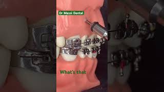 Dental Braces Orthodontics Teeth Alignment